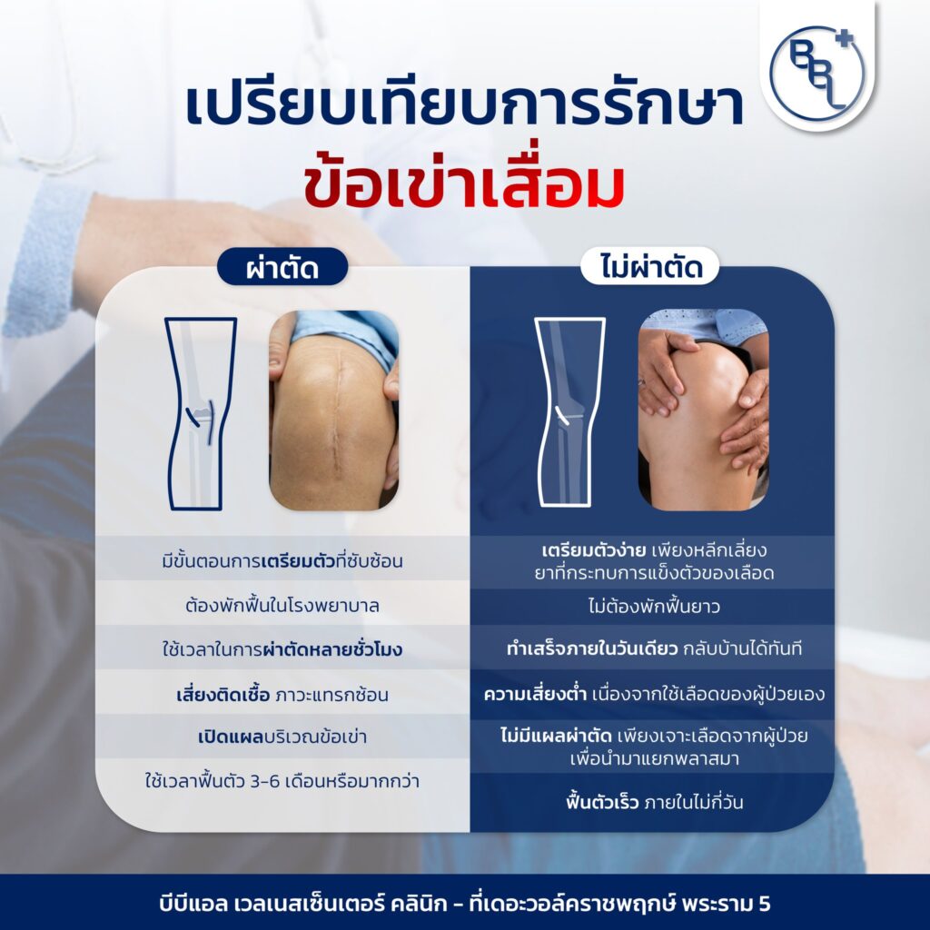 อินโฟกราฟิกเปรียบเทียบการรักษาข้อเข่าเสื่อมแบบผ่าตัดและไม่ผ่าตัด โดย BBL Wellness Center