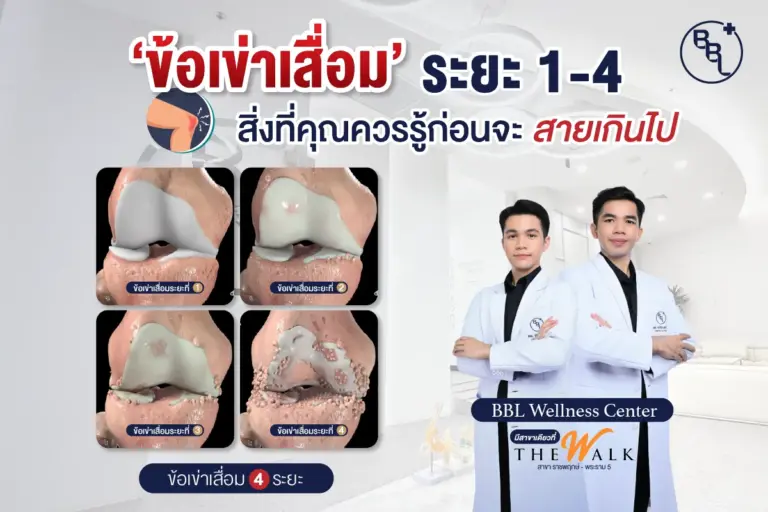 ภาพจำลองข้อเข่าเสื่อมทั้ง 4 ระยะ พร้อมทีมแพทย์จาก BBL Wellness Center แนะนำการดูแลก่อนจะสายเกินไป