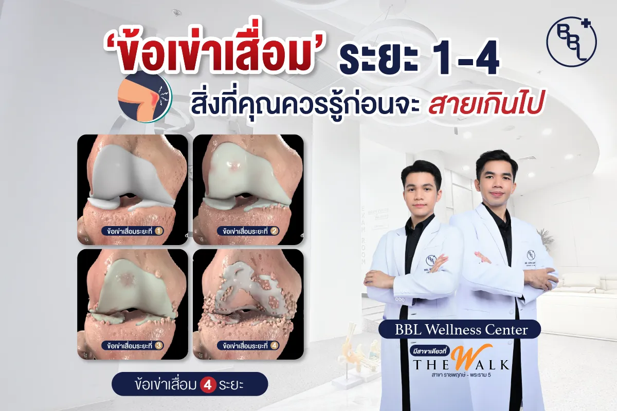 ภาพจำลองข้อเข่าเสื่อมทั้ง 4 ระยะ พร้อมทีมแพทย์จาก BBL Wellness Center แนะนำการดูแลก่อนจะสายเกินไป